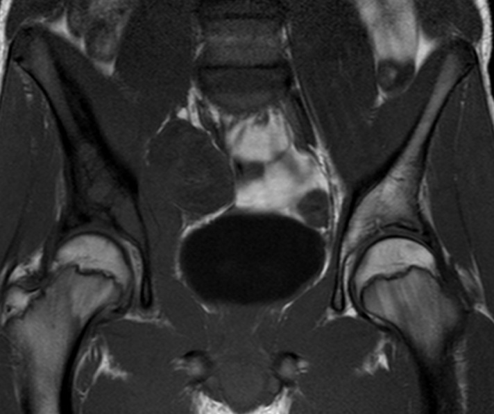 Figure 5 for case Ewing sarcoma ( RID4522 )
